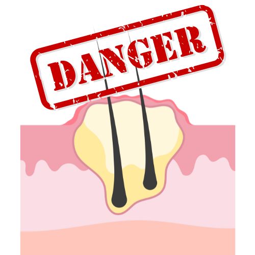 Are Cysts Dangerous